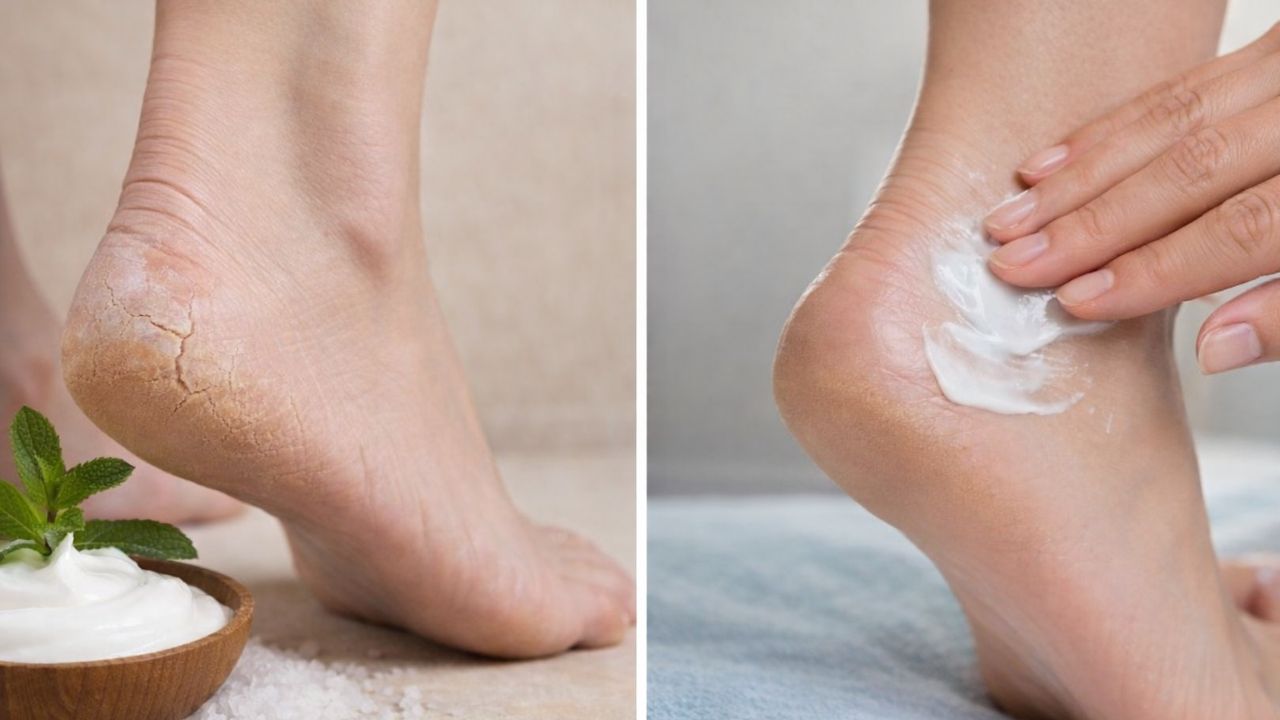 Fast Ways to Repair Dry Cracked Heels at Home With Gentle Kitchen Ingredients That Heal Skin